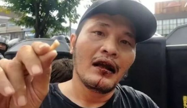 Sembari Pegang Giginya yang Copot, Nicho Silalahi Mengaku Jadi Korban Pemukulan Polisi