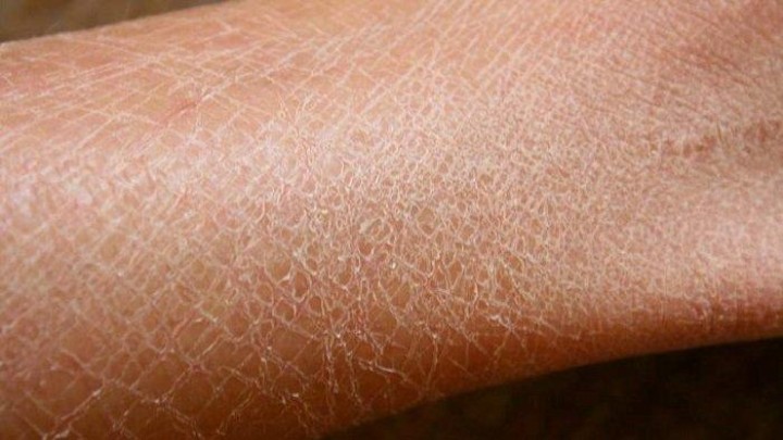 Mengenal Xerosis Cutis : Hilangnya Kelembaban Kulit yang Disampaikan dr. Mira Trisna Murti, Sp.DV