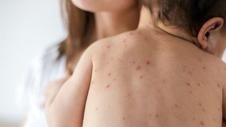 Dokter, Bagaimana Penanganan Medis untuk Anak yang Terinfeksi Penyakit Campak?