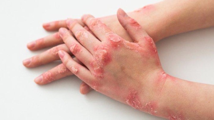 Mengapa Penderita Psoriasis Kerap Mendapat Stigma Negatif? Ini Penjelasan Dokter Spesialis Kulit
